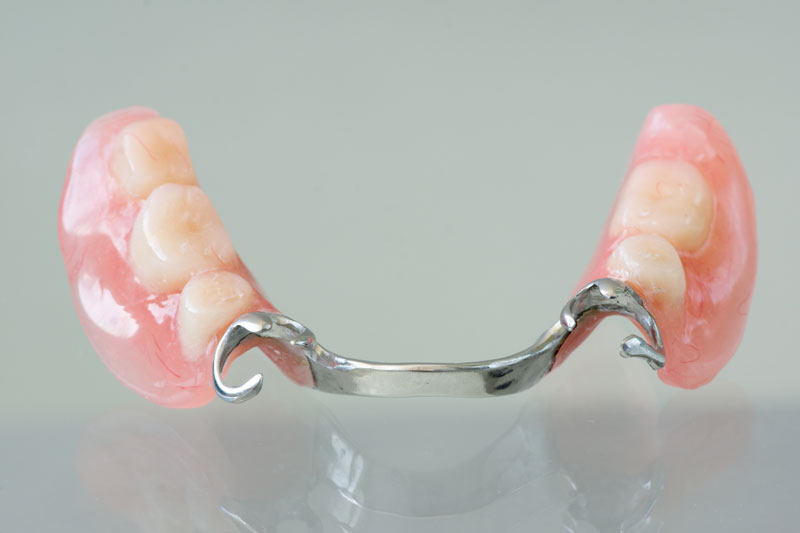 Oberkiefer teilprothese Zahnprothesen Kosten